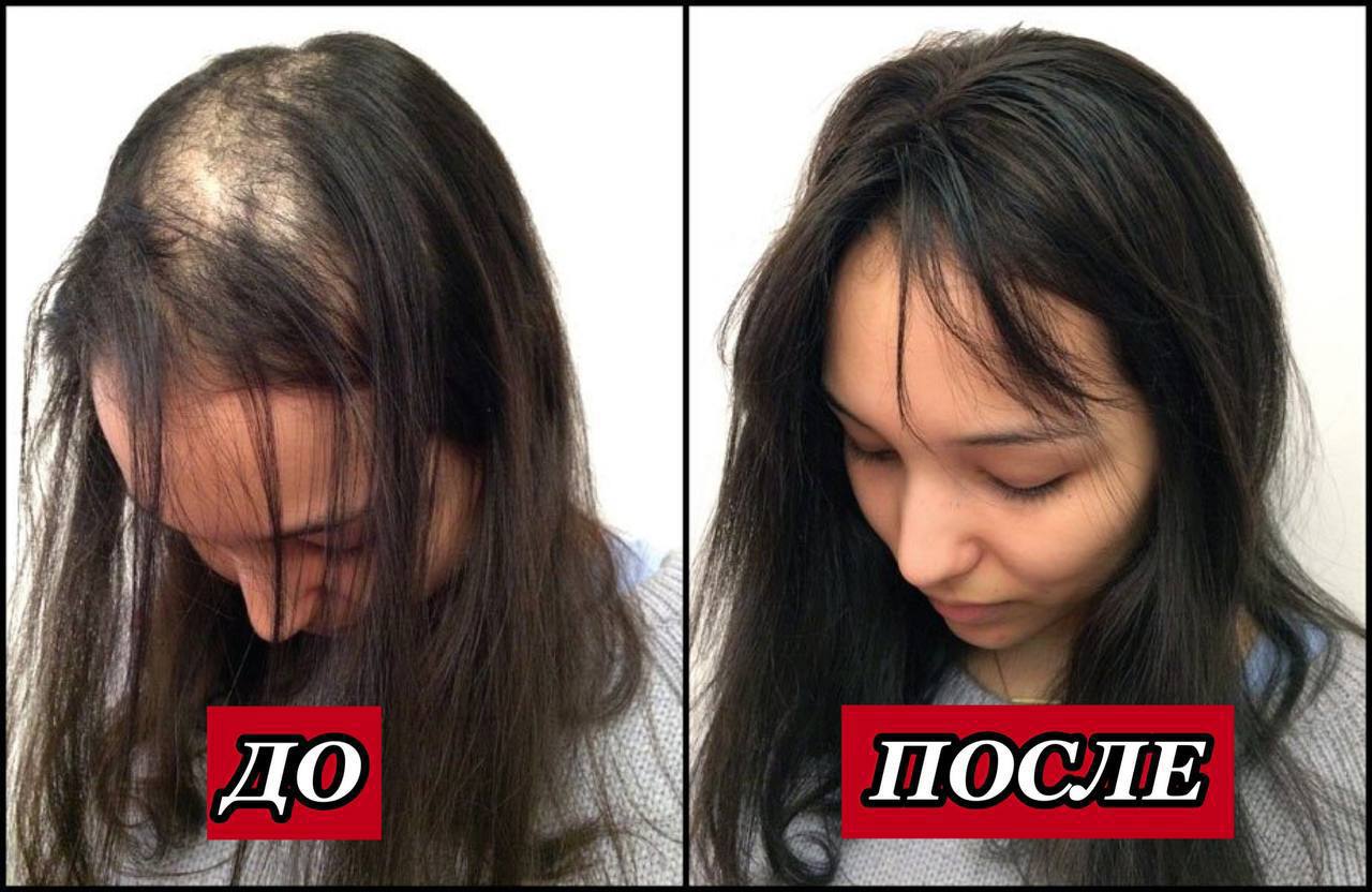Выпадение волос до и после