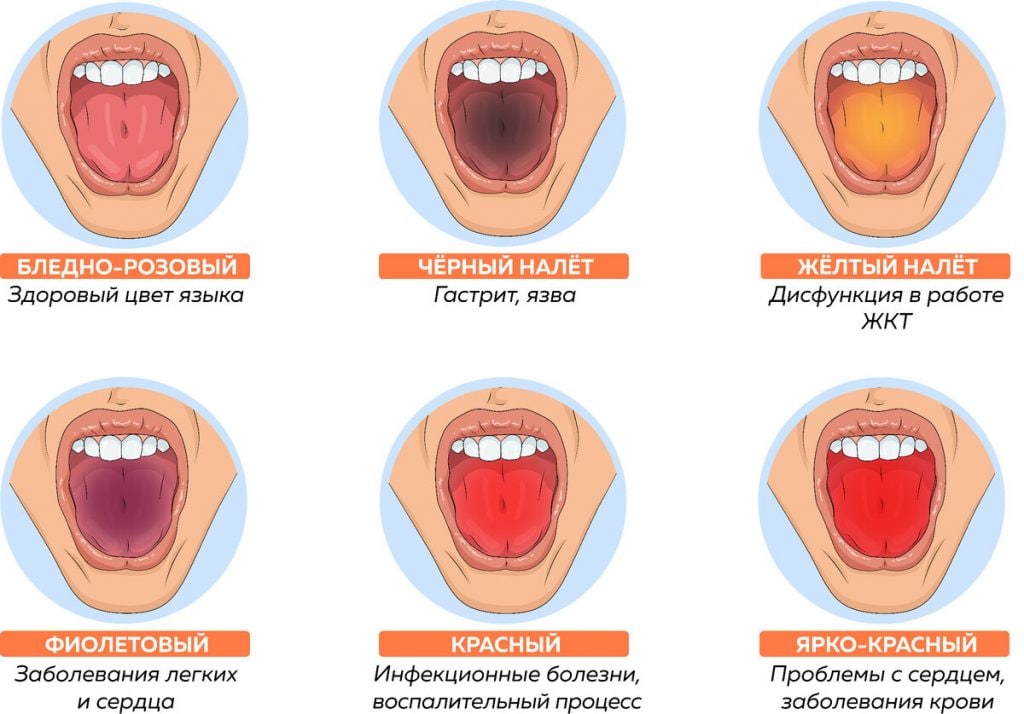 О чем говорит цвет языка о каких заболеваниях в картинках