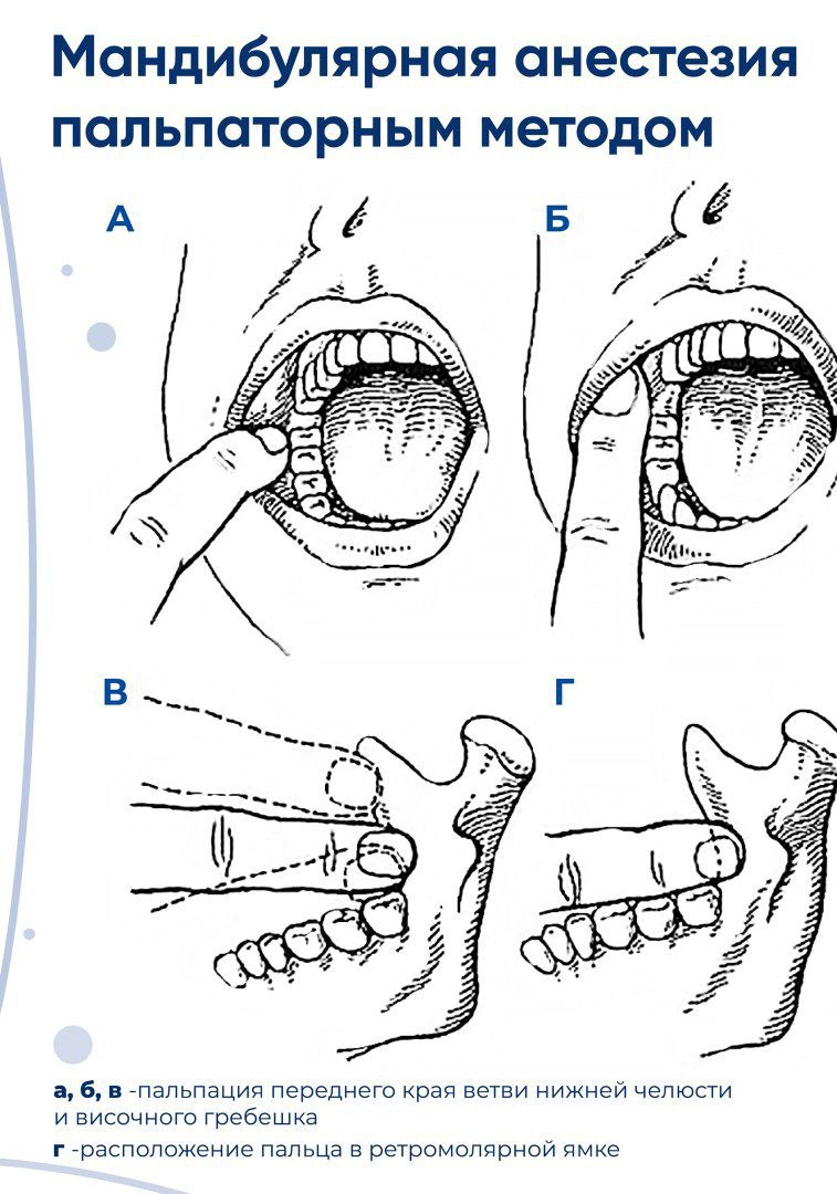 Мандибулярная анестезия схема
